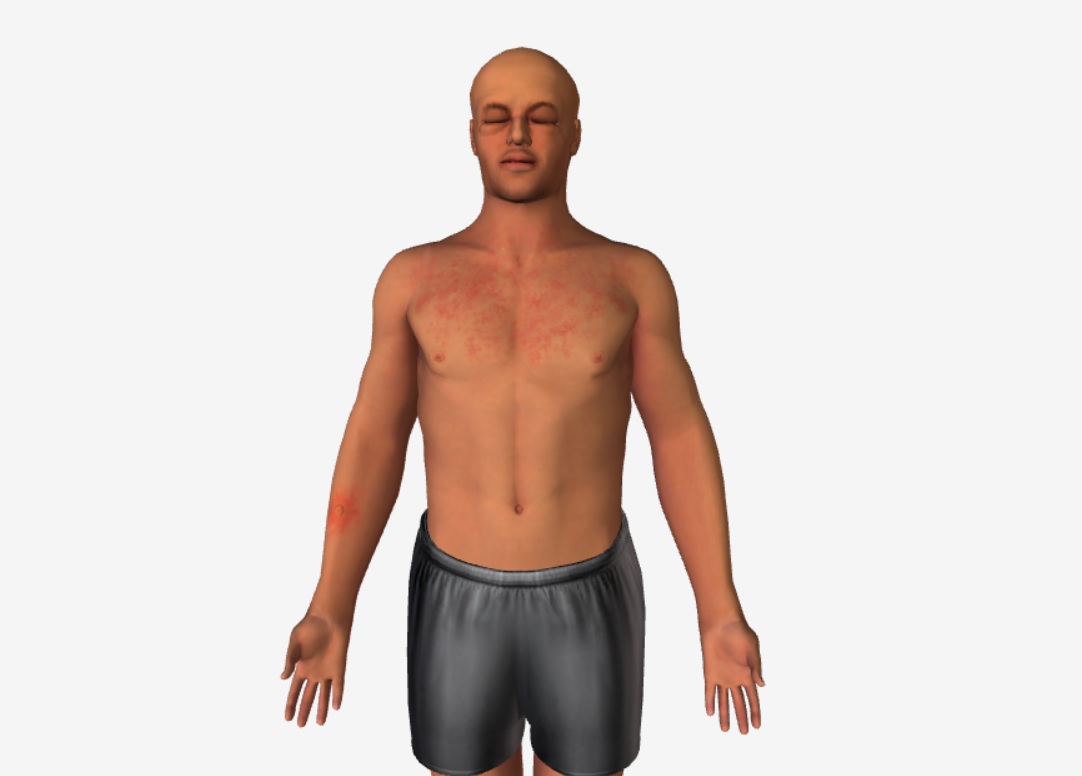 icd 10 code for systemic allergic reaction